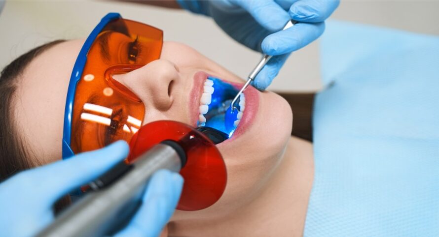 How Long Do Root Canals Last