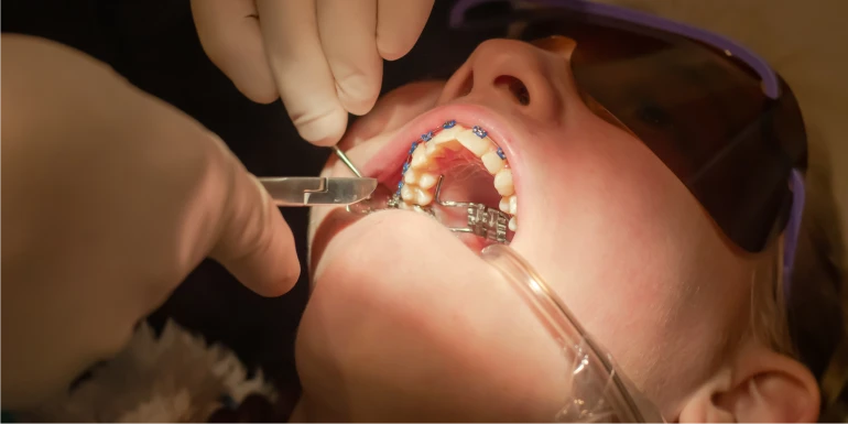 How Long Does Dental Bonding Last