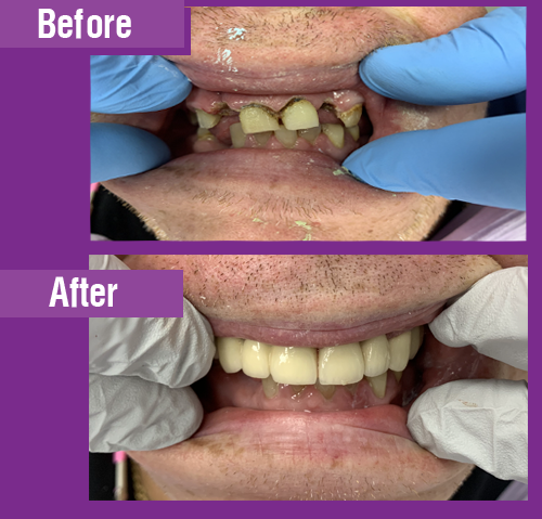 PFM Crowns & Bridges
