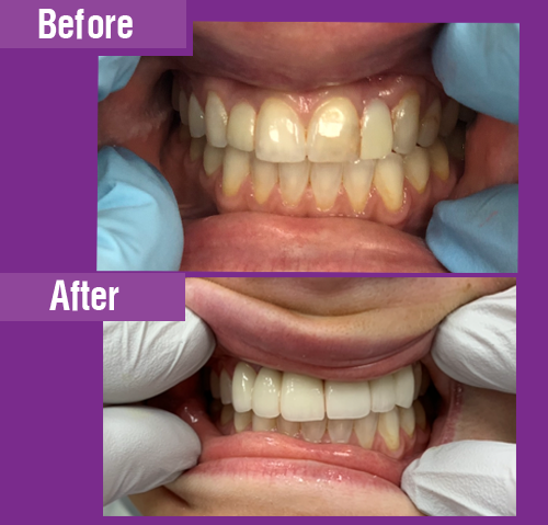 Zirconia Bridges