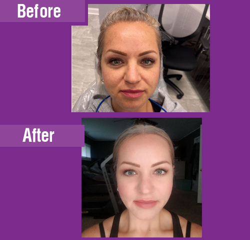 Botox & Nasolabial Fold Filler Treatment