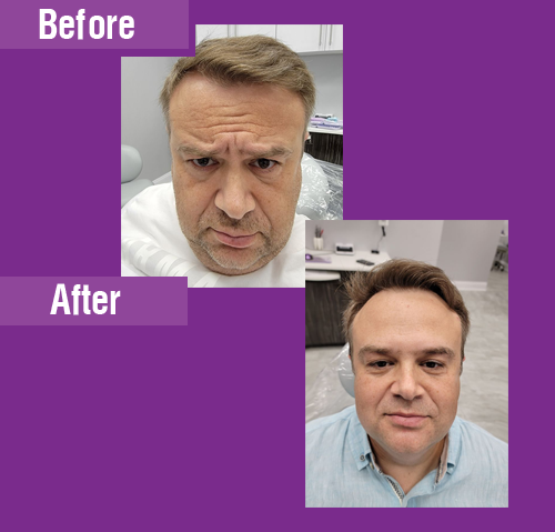 Botox Treatment