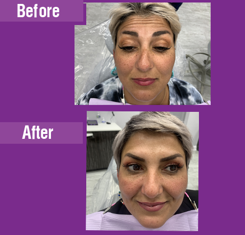 Botox Treatment