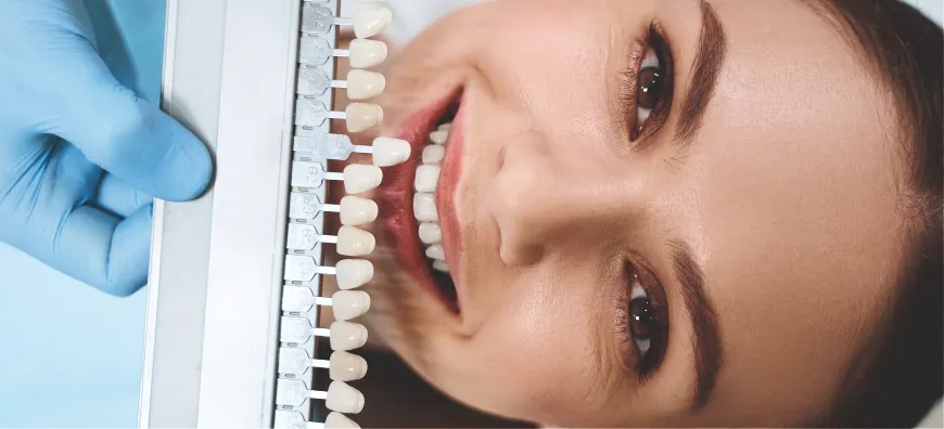 veneers