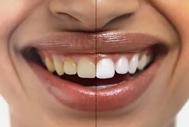 whitening result