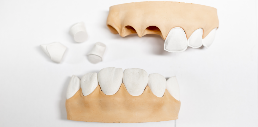 Porcelain PFM Crowns