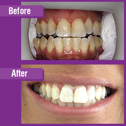 WHITENING