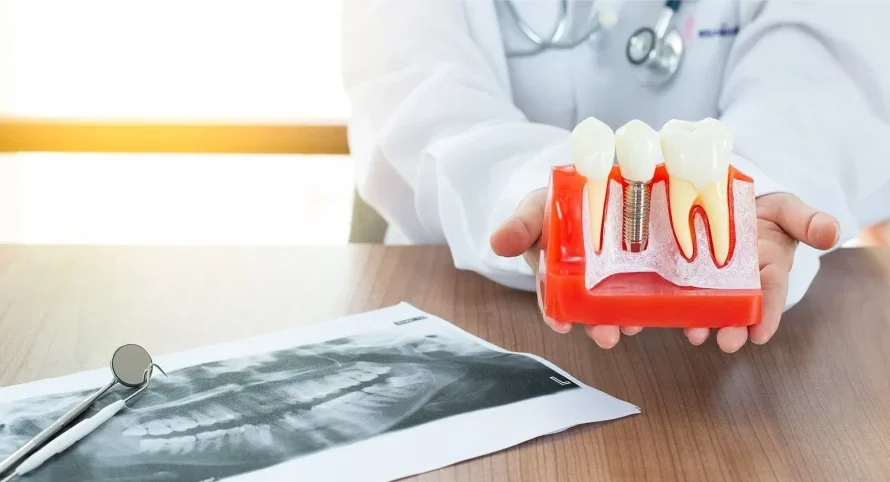 dental implant