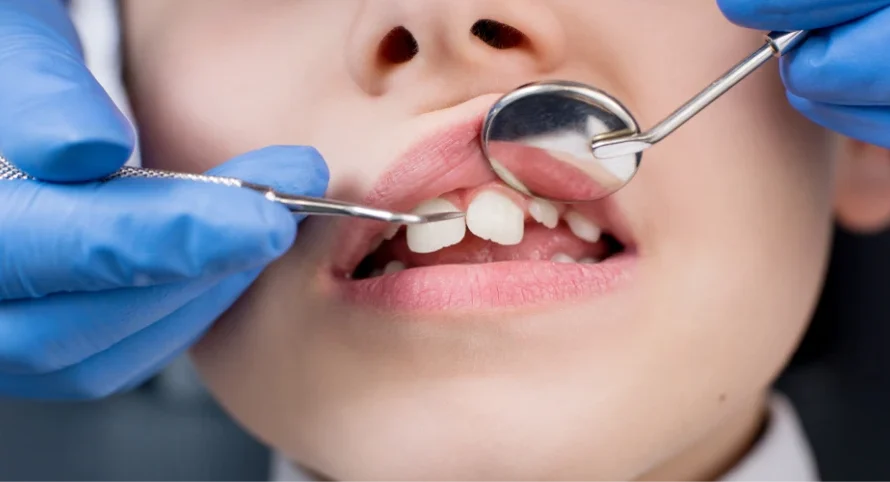 Causes of Buck Teeth