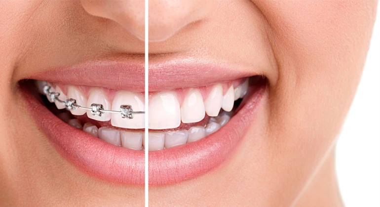 Invisalign Vs Braces