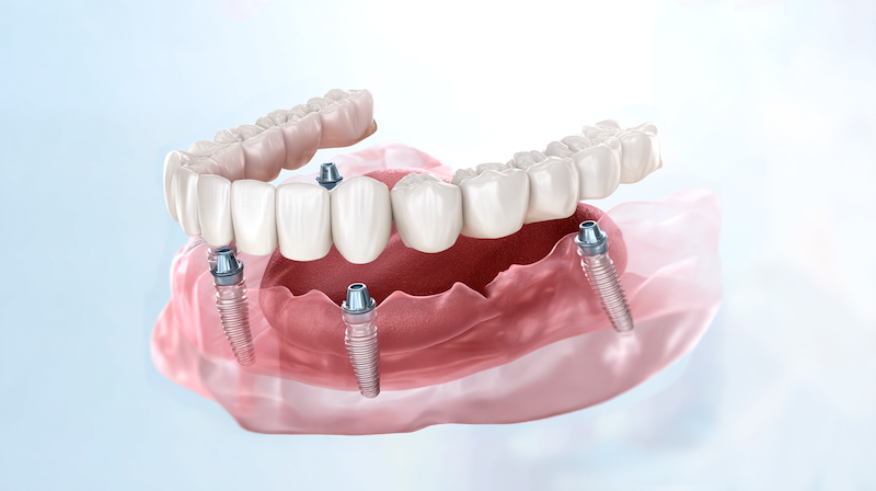 All-On-X Dental Implants