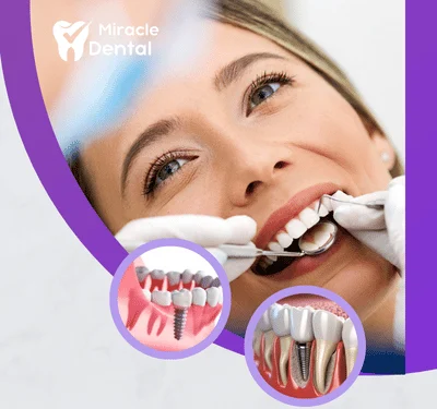 Dental implants